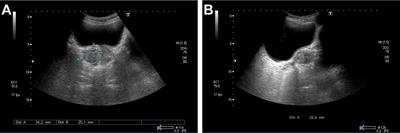 Case Report: Prostate Adenocarcinoma With Mucinous Features of Normal-Level Serum PSA, Atypical Imaging, Biopsy-Negative, and Peculiar Urethrocystoscopic Manifestation